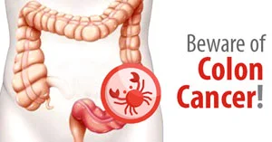 Beware of Colon Cancer