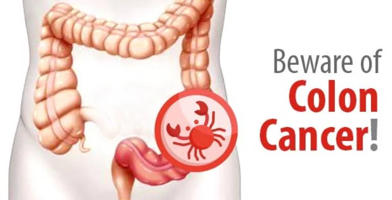 Beware of Colon Cancer